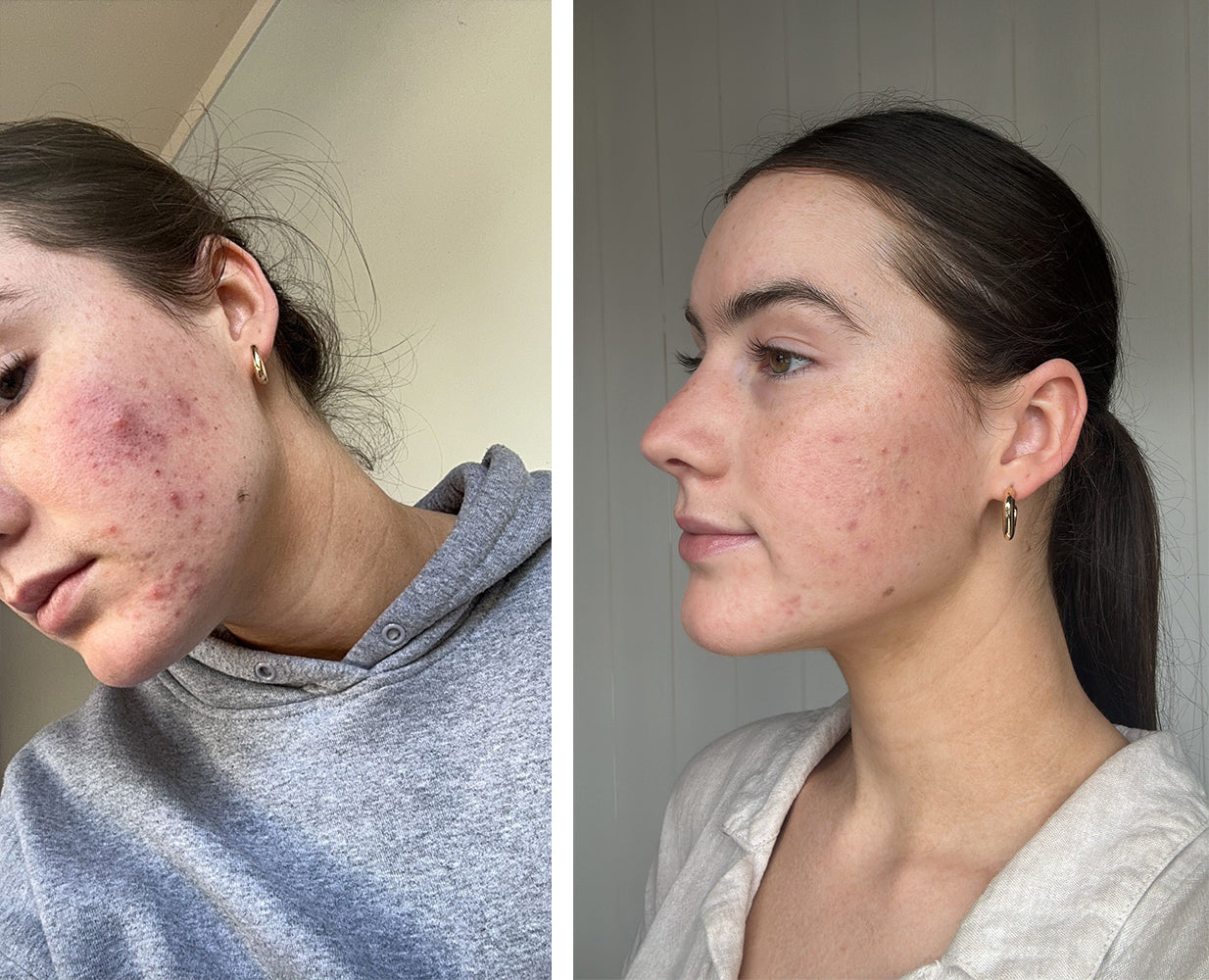 Abi Dark shares her Skin Story