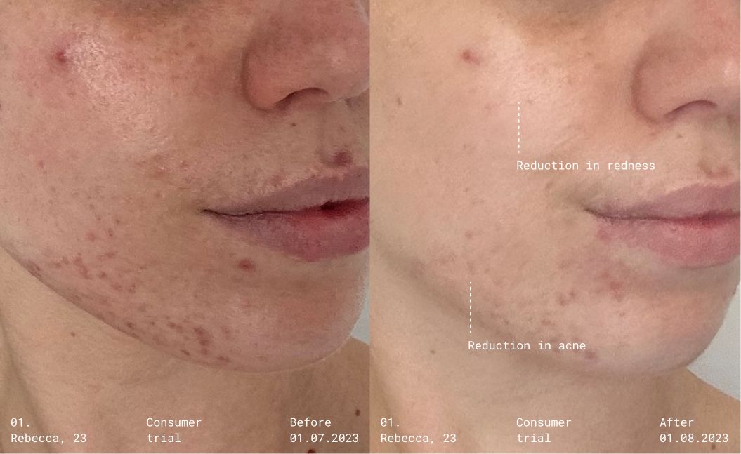 emma-lewisham-supernatural-blemish-serum-before-and-after.jpg